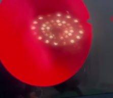 Yıllarca fark etmedi, estetik ameliyatta ortaya &ccedil;ıktı: Burunda rinolit şoku!