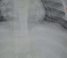 Bebeğin sırtından 2 santimetrelik metal tel &ccedil;ıkarıldı