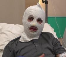 &Ccedil;akmağına gaz doldurduğu t&uuml;p&uuml;n patlamasıyla y&uuml;z&uuml; yandı