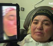 Hastalığı y&uuml;z&uuml;nden yıllarca evden &ccedil;ıkamadı, şimdi ise &ccedil;ekinmeden &ccedil;ıkabiliyor