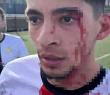 Yeşil sahada kan g&ouml;vdeyi g&ouml;t&uuml;rd&uuml;: 3 futbolcu hastanelik oldu