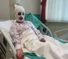 D&uuml;d&uuml;kl&uuml; tencere patladı: 2 &ccedil;ocuk annesi kadın ağır yaralandı