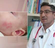 Uzmanından uyarı: Egzamalı &ccedil;ocuğa ezbere diyet yaptırmayın