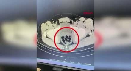 Midesinden yarım kilo metamfetamin çıktı