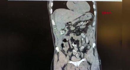 3 bin kilometre uzaktan midesinde uyuşturucu getirdi!