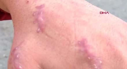 Bu vaka d&uuml;nyada ilk olabilir! Elini ısıran kedi gen&ccedil; adamın kabusu oldu