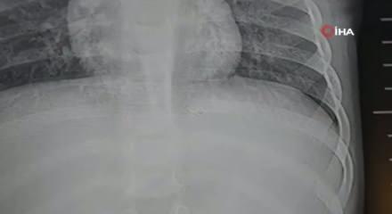 Bebeğin sırtından 2 santimetrelik metal tel &ccedil;ıkarıldı