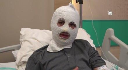 &Ccedil;akmağına gaz doldurduğu t&uuml;p&uuml;n patlamasıyla y&uuml;z&uuml; yandı