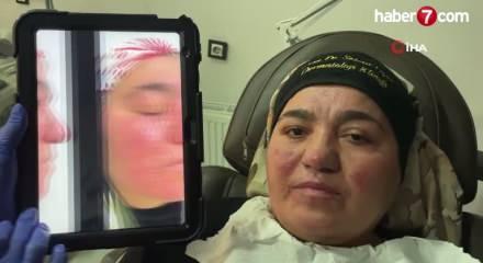 Hastalığı y&uuml;z&uuml;nden yıllarca evden &ccedil;ıkamadı, şimdi ise &ccedil;ekinmeden &ccedil;ıkabiliyor