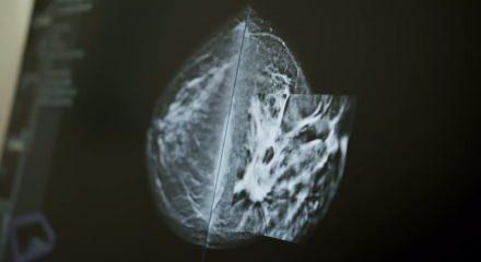 Meme kanseri taramasında yeni teknoloji: ABUS ile daha net g&ouml;r&uuml;nt&uuml;