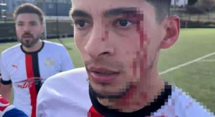 Yeşil sahada kan g&ouml;vdeyi g&ouml;t&uuml;rd&uuml;: 3 futbolcu hastanelik oldu