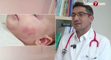 Uzmanından uyarı: Egzamalı &ccedil;ocuğa ezbere diyet yaptırmayın