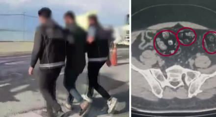 Yolcunun midesinden 62 par&ccedil;a uyuşturucu &ccedil;ıktı