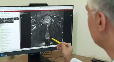 Rektum kanserine ilişkin uzman isim a&ccedil;ıklama yaptı: T&uuml;m&ouml;r tamamen kaybolursa ameliyat şart olmayabilir