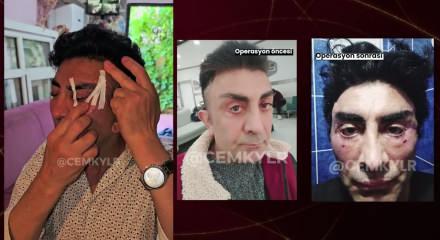 Estetik operasyon k&acirc;busu: G&ouml;zlerini kapatamaz hale geldi, su&ccedil; duyurusunda bulundu!