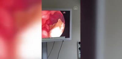 Yakalanmamak i&ccedil;in yuttuğu uyuşturucu endoskopi ile &ccedil;ıkartıldı
