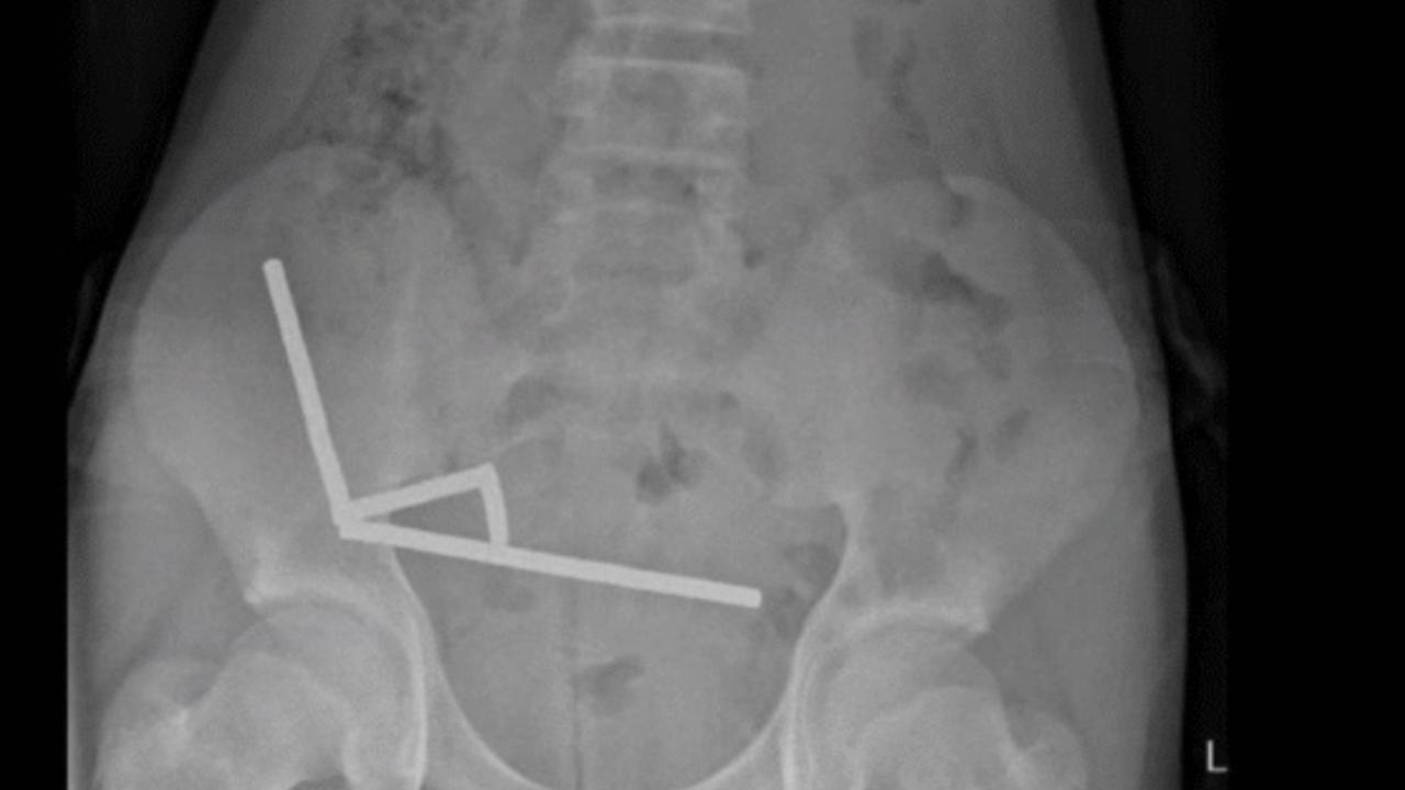 200 mıknatıs yuttu, bağırsaklarının bir kısmını kaybetti