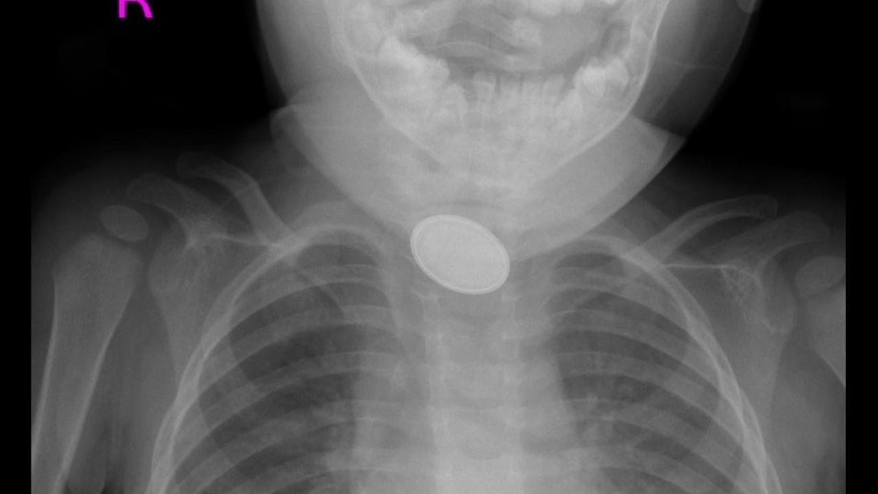 Kayseri’de 15 aylık bebeğin yemek borusuna pil ve lego parçası kaçtı