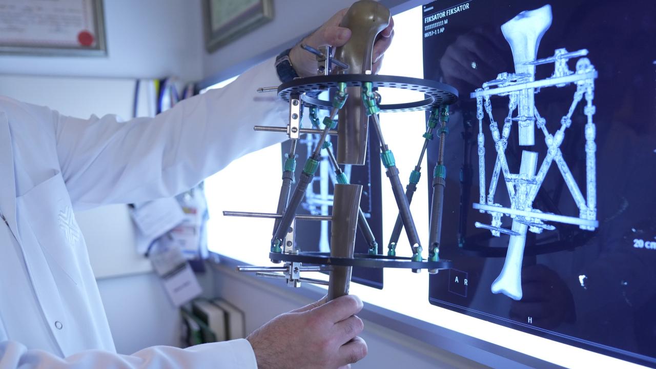 Boy kısalığında çığır açan tedavi: Günde 1 milimetre uzatan yöntem