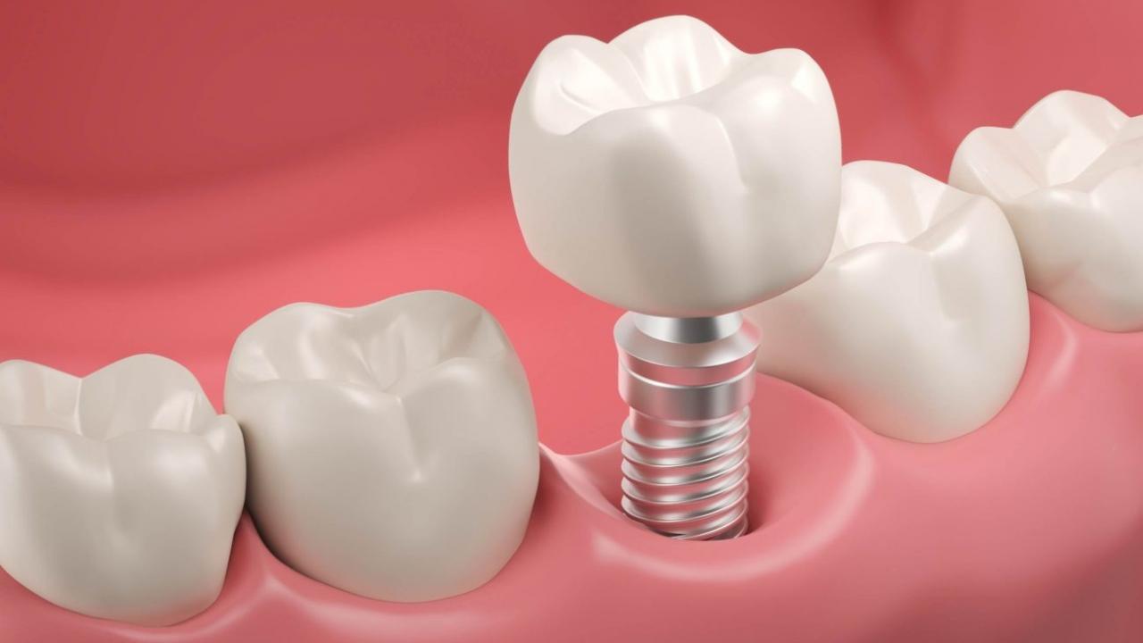 Diş tedavisinde implant SSK kapsamına giriyor