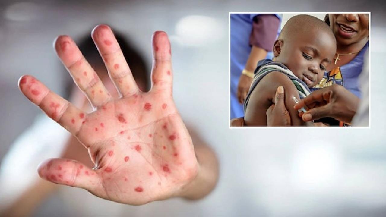 Nijerya'da kızamık salgını! Çok sayıda 15 çocuk öldü