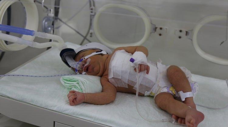 Şanlıurfa'da siyam ikizi bebekler ameliyatla ayrıldı