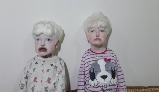 Albino kardeşler görenlerin yüreklerini burkuyor