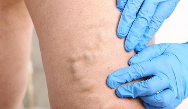 varicoză de ce a ales vian cât de mult este îndepărtarea varicozei