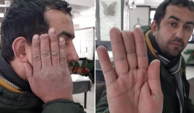 Elinde kopan parmağı ile hastane hastane gezmişti! Yeni gelişme…