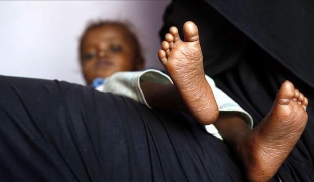 Yemen'deki savaşta ellerini kaybeden küçük kız: Resim tutkumdu