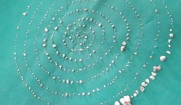 7 yaşındaki çocuğun çenesinden çıkanlar şok etti!