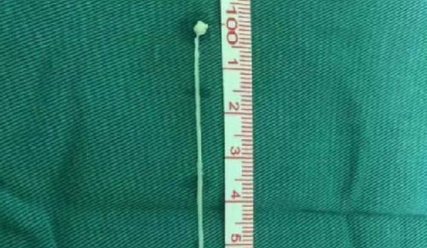 Beyninde kurtla 30 yıl yaşadı
