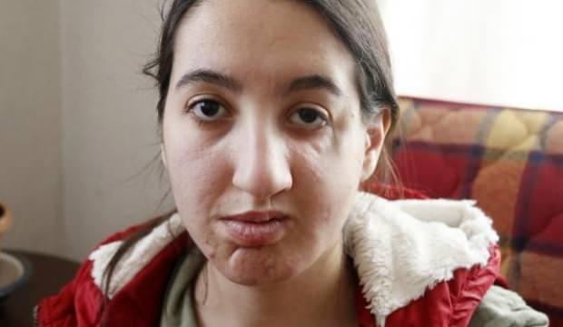 Elmacık kemiği olmadan d&uuml;nyaya geldi! Yardım &ccedil;ağrısı