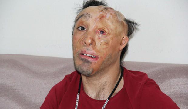6 aylıkken yüzü yanmıştı, operasyonuna korona engel oldu