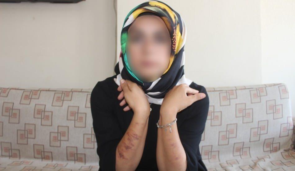 Lazer Epilasyon Haberleri Yasemin