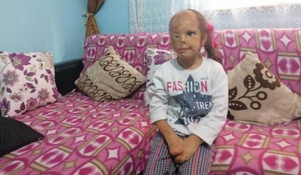 Bebekken yüzü yanan Dilara, ameliyat için yardım bekliyor