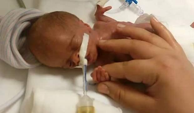 Parmak bebek olarak doğdu, 4.5 yıl y&uuml;r&uuml;yemedi! Şimdi...