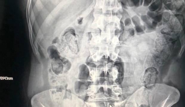 Yolcu kılığındaki kuryelerin midelerinden 103 paket uyuşturucu çıktı