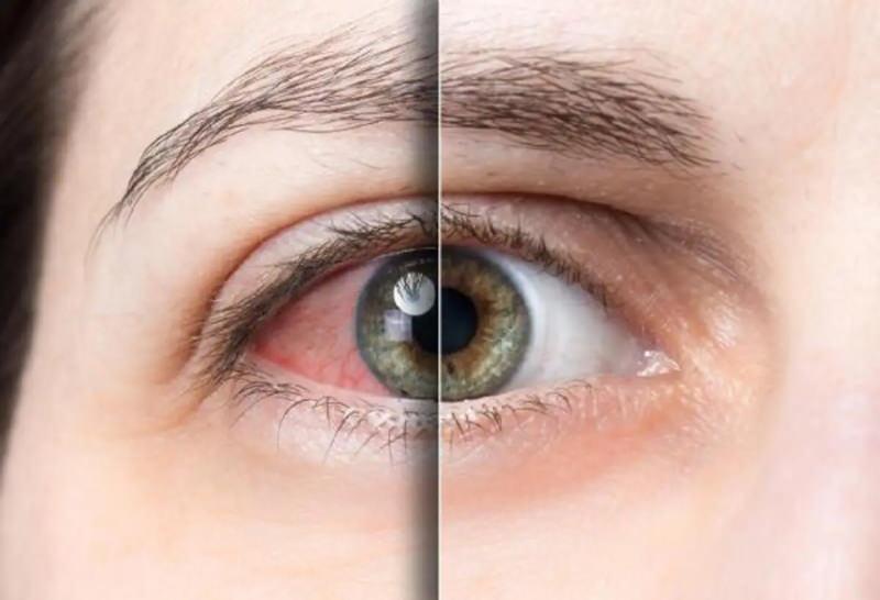 Konjonktivitin olan göz ile normal göz arasındaki fark