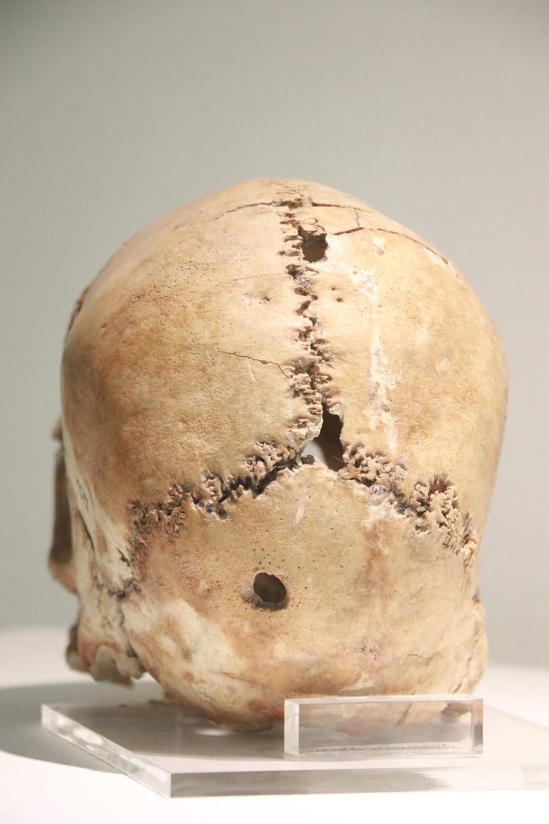 Dünya’nın ilk beyin ameliyatı Aksaray’da yapıldı! Tam 10 bin 500 yıl önce