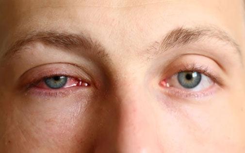 Göz alerjisi neden olur? Nelere dikkat etmeliyiz