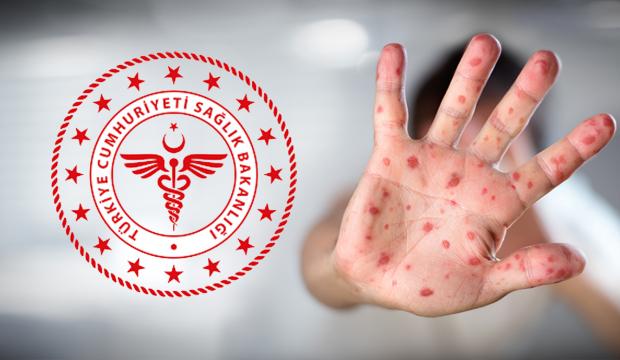 Maymun Çiçeği virüsü nedir, nasıl bulaşır? Belirtileri ve korunma yöntemleri belli oldu