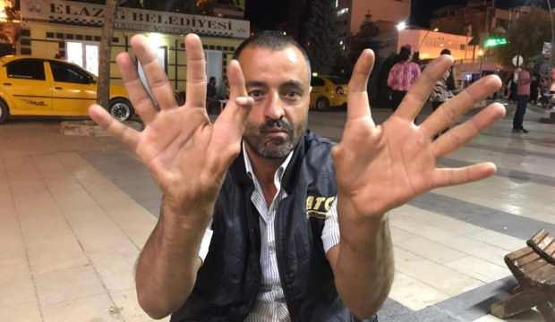 11 parmaklı adamı görenler inanamıyor! Oğlu 13 kızı da 11 parmaklı