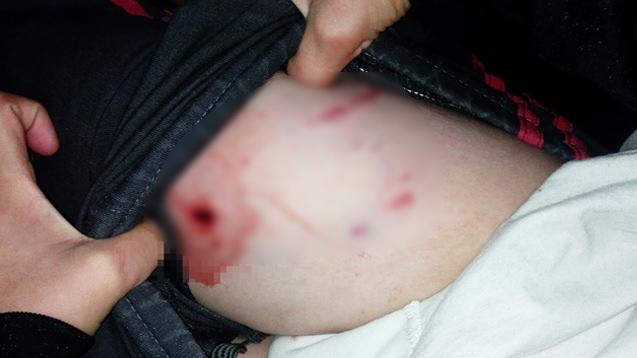 Tekirdağ'da pitbull saldırısına uğrayan 10 yaşındaki Sercan Baran Çılgın