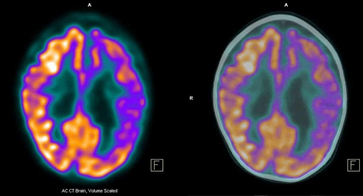 Yapay zeka ile Alzheimer hastalığının teşhisinin hızlandırabileceği iddia ediliyor
