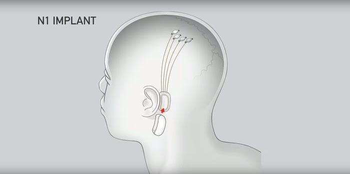 Çip, elektrotlar beyne geçirilirken kulağın arkasına oturacak şekilde tasarlanmıştır. Neuralink/YouTube