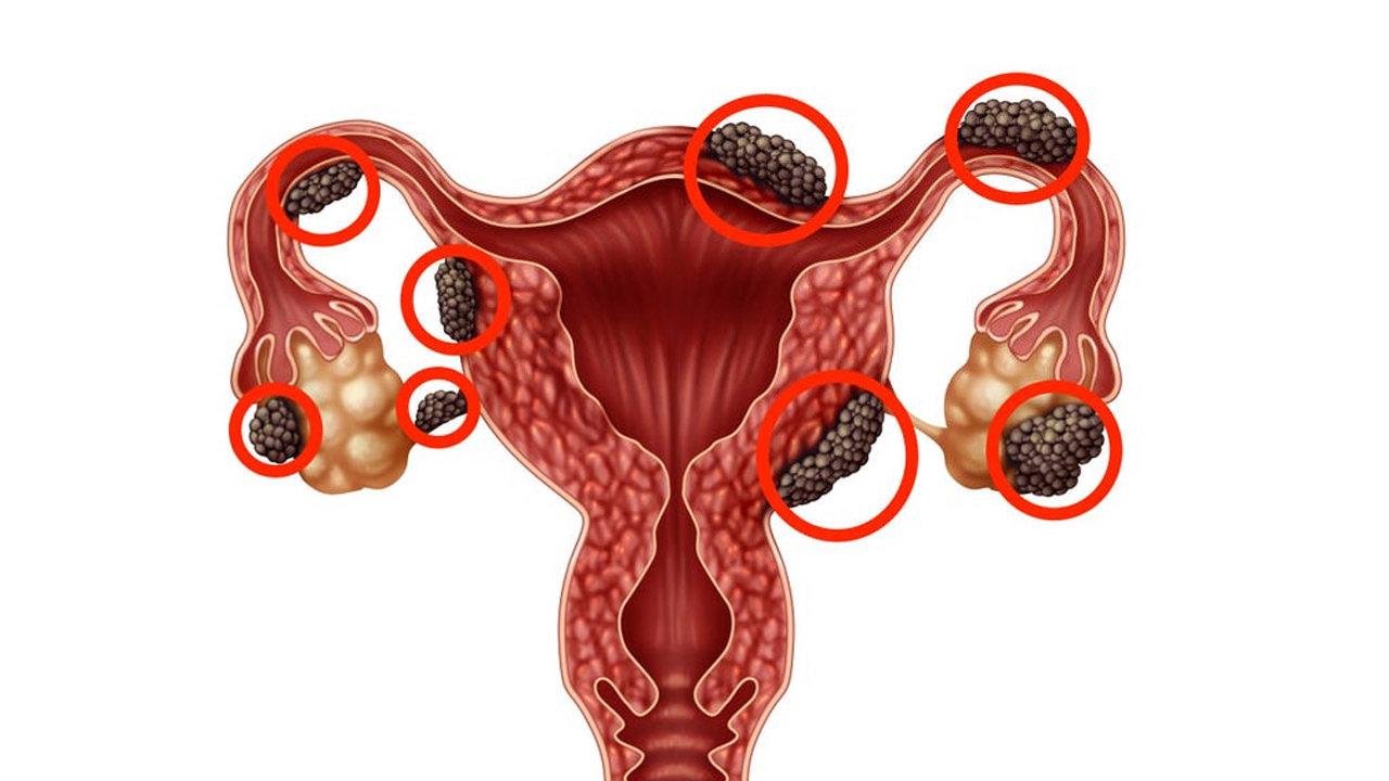 Endometriozis nedir, belirtileri nelerdir? Endometriozis tedavisi var mıdır?