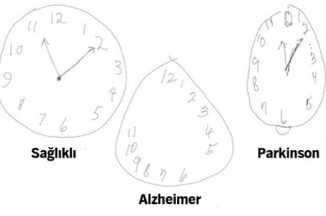 Saat çizme testi ile demans teşhisi sonuçları