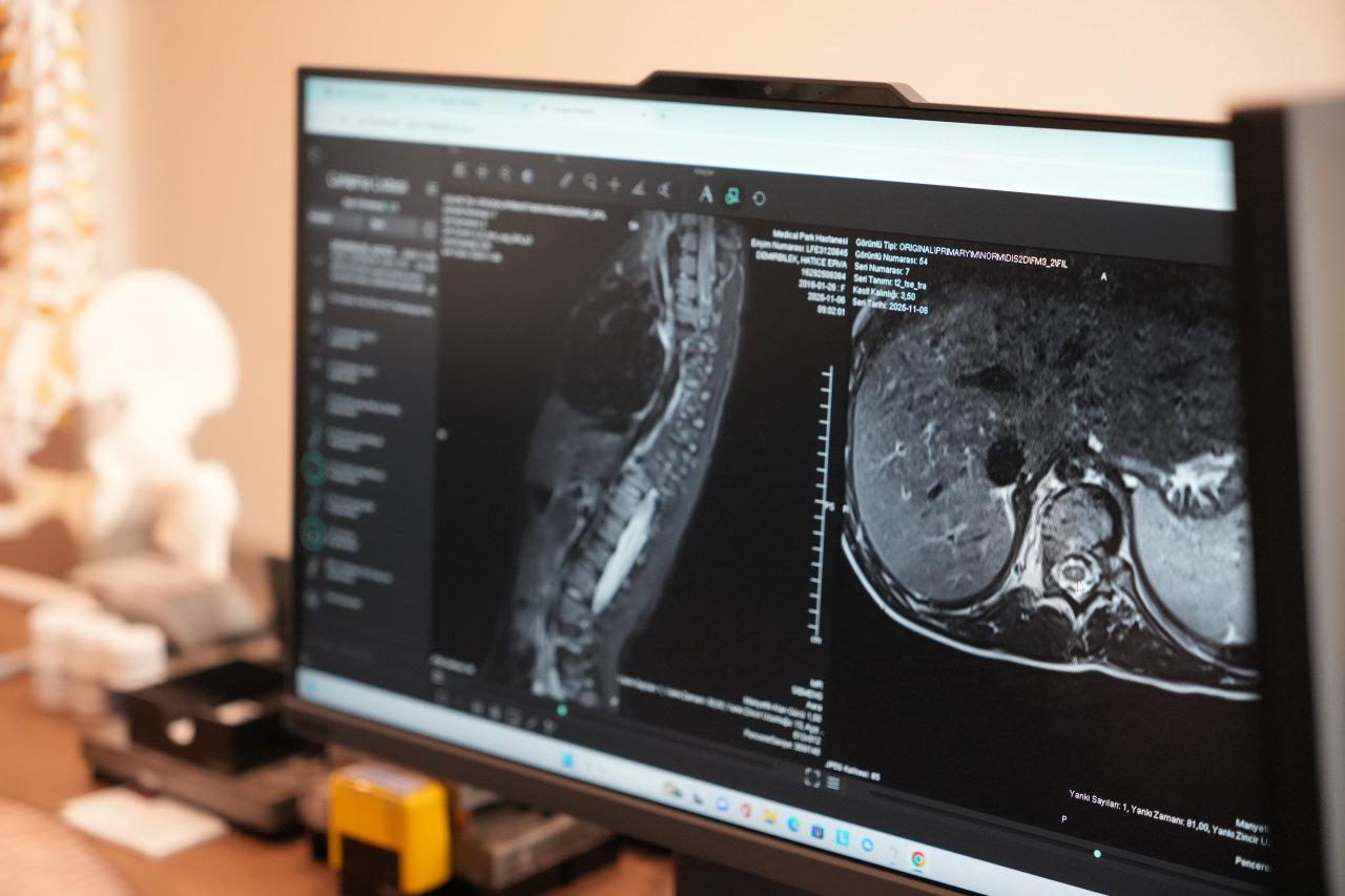 Skolyoz hastalığında sahip bir kişinin röntgen görüntüsü.