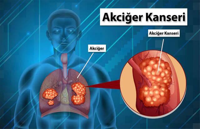 Akciğer ve akciğer kanserini gösteren bir animasyon fotoğraf